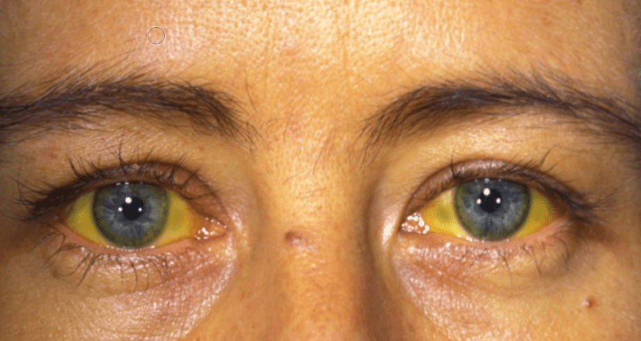 Гепатит ц - если вы заболели